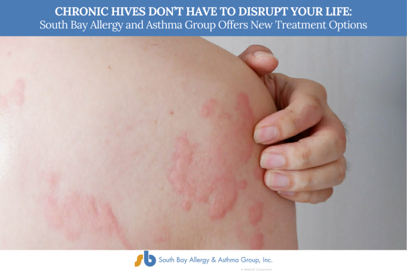 Chronic Hives Don’t Have to Disrupt Your Life South Bay Allergy and Asthma Group Offers New Treatment Options