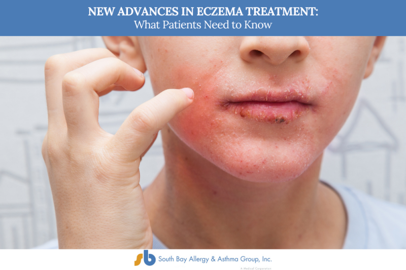 New Advances in Eczema Treatment: What Patients Need to Know